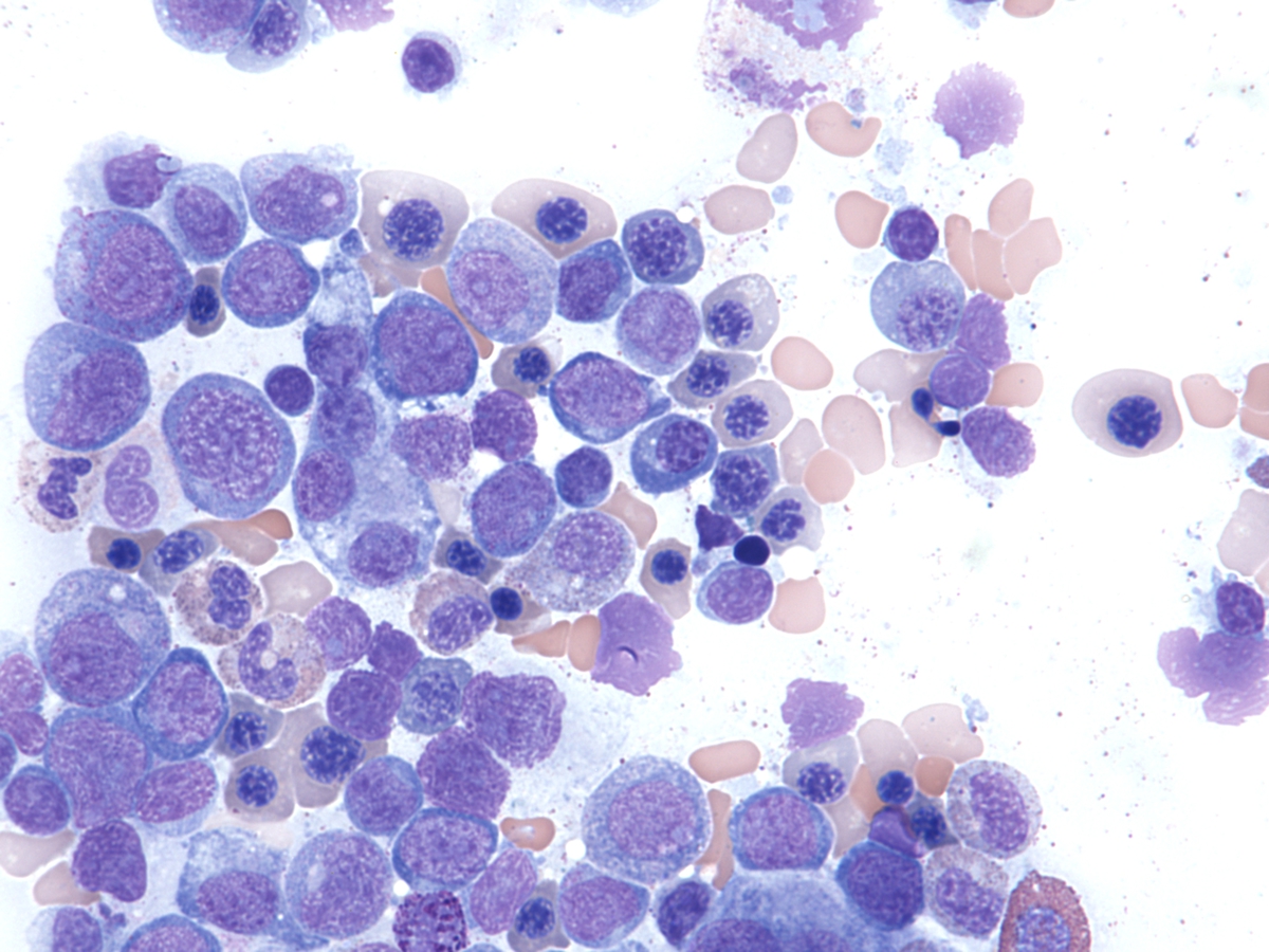 Bone marrow aspirate, Wright-Giemsa, 60x. At initial diagnosis, dysplasia in both the erythroid and megakaryocytic lineages was evident.
